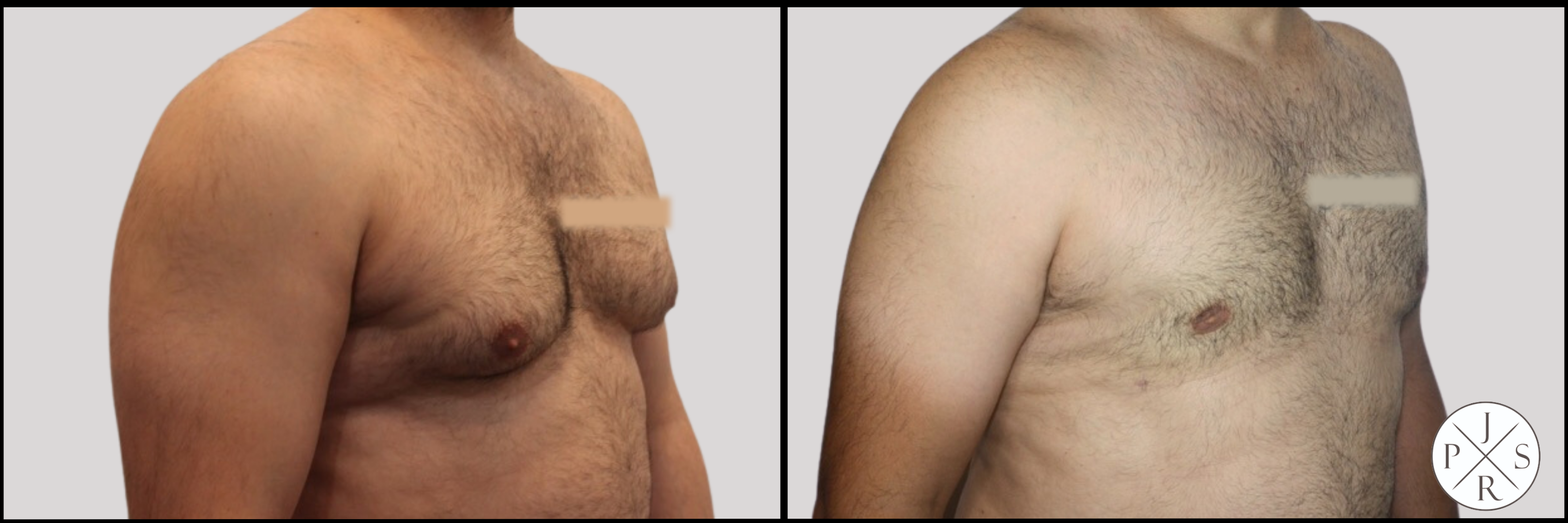Gynaecomastia Before & After Image